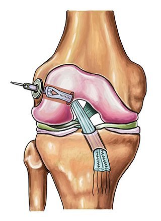 acl surgery in singapore