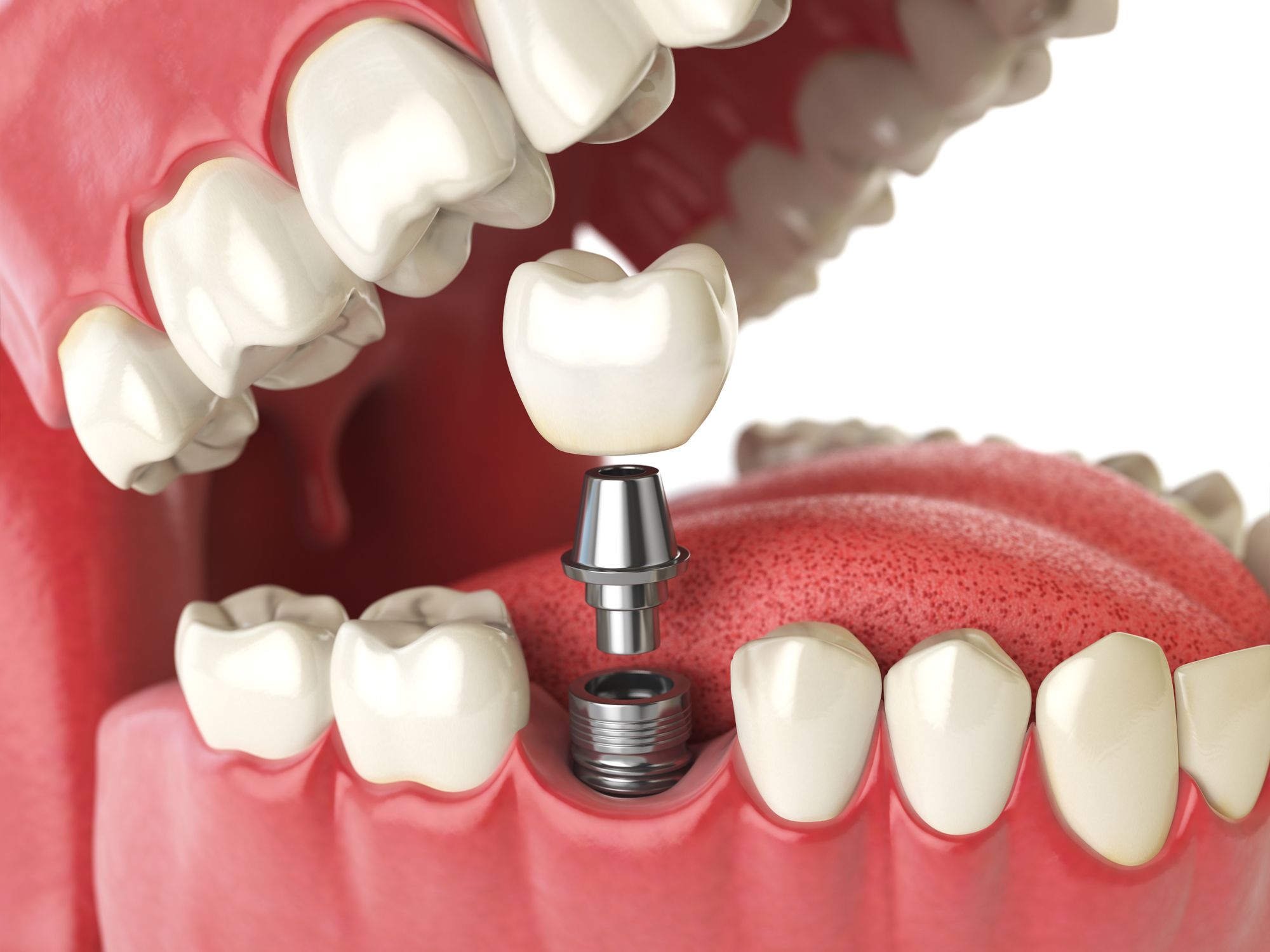 dental implants Singapore